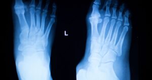 ankle fracture doctor